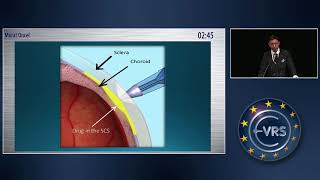 A Novel Drug Delivery Route for Treatment of Diabetic Macular Edema