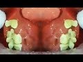 Kelly's Tonsil Stone Popping, Removal & Treatment!