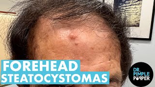 A Forehead \u0026 Face COVERED in Steatocystomas! Dr Pimple Popper Non-Stop Extractions