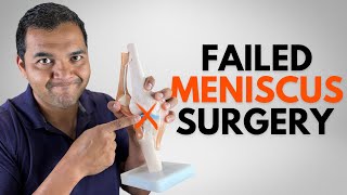 5 Ways To Tell You Might Unfortunately Have A Failed Meniscus Surgery