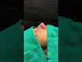 Incredible Post Op Asian Rhinoplasty Before And After