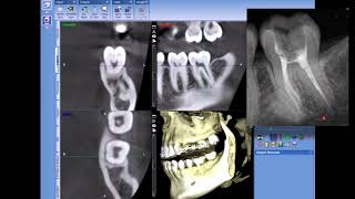 Case of the day: Difficult Root Canal #18 - 4 canals w/CBCT