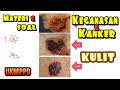 Keganasan Kulit Kanker Kulit BCC SCC Melanoma Maligna dan latihan Soal UKMPD Dermatovenerologi