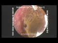 Ear wax removal, Golden earwax fungus dry sheet cleaning 20241121