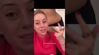 Stretch Marks Transformation Part 2 #shorts