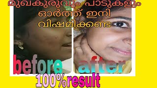 മുഖകുരുവിനും കറുത്ത പാടുകൾക്കും വേണ്ടി  /pimple and dark spot removal face pack at home