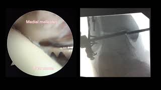 Arthroscopically Assisted Open Reduction–Internal Fixation of Ankle Fractures...