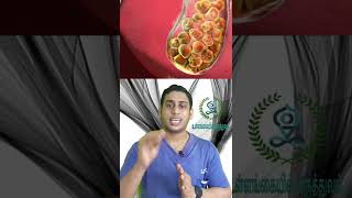 பித்தப்பை கற்கள் ஏற்பட காரணம்| Gall stones formation causes tamil | Gall stones types - part 2