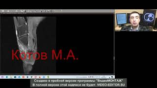 Стресс перелом плюсневой кости. Ролик №30.