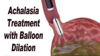 Achalasia Treatment with Endoscopic Balloon Dilation