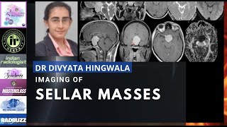 IMAGING OF SELLAR MASSES | DR DIVYATA HINGWALA | MRI TEACHING COURSE | PITUITARY MICROADENOMA