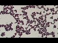 Gram positive cocci in singles, pairs and clusters of Staphylococcus hominis