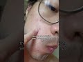 microneedle pimple patches 🤯 do they work shorts skincare acne pimplepopping