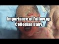 Importance of Collodian Baby Follow up | Phenotype | Neonatology | Pakistan | Doctor Xydi