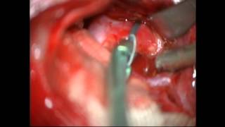 Clip reconstruction fusiform MCA aneurysm