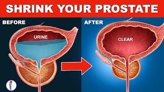 Strictly Avoid these 5 Foods if you have Enlarged Prostate | Prostate Enlargement Treatment | BPH
