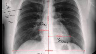 Chest x-ray -Cardiothoracic Ratio -CARDIAC SIZE - Cardiomegaly