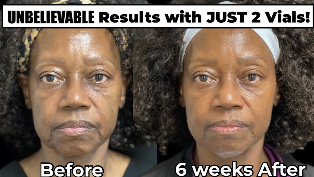 Sculptra Before And After Face Pictures