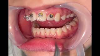 هەنگاوەکانی ڕاستکردنەوەی ددان @shkarlatifdentalcenter