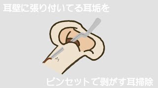 【ASMR】耳壁に張り付いてる耳垢をピンセットで剥がす耳掃除　Ear Cleaning 【No Talking】