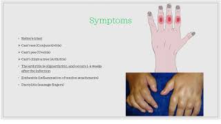 Reactive arthritis / Post-infectious arthritis [Essential medicine]