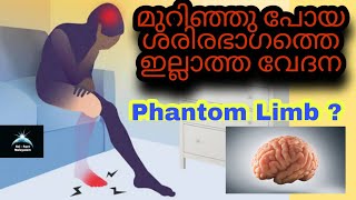 മുറിഞ്ഞു പോയ ശരീരഭാഗത്തെ വേദനയ്ക്ക് കാരണമായ Phantom Limb, explaining in Sci Fact Malayalam