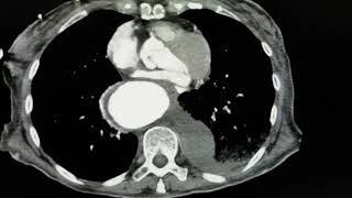 An Unusual Case of Hematemesis  Aortic Aneurysm  Axial CT  JETem 2018