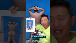 Buttock Reduction (BBL Revision) 1 month post op