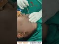 Face Vaser - Liposuction | Divine Cosmetic Surgery | Dr Amit Gupta - March 2021