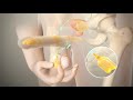 Penile Prosthesis Animation - Utah Men's Health