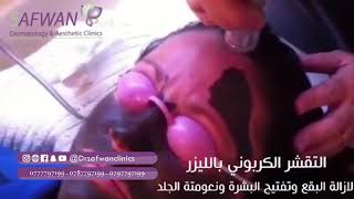 التقشير الكربوني  - عيادات الدكتور صفوان - drsafwanclinics