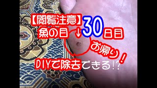 【閲覧注意】魚の目をDIYで除去する動画【30日目】