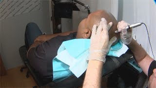 Fighting hair loss? Some Valley men turning to scalp tattoos