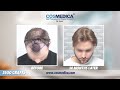 hair transplant in turkey hair transplant results of cosmedica