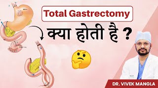 Total gastrectomy: When and why? Dr Vivek Mangla। टोटल गैस्ट्रेक्टोमी: कब, क्यों और उसके बाद का जीवन