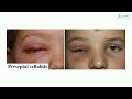 orbital cellulitis