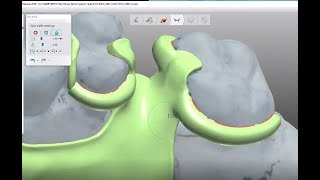 3Shape CAD training for smaller saddles on your RPD-#4