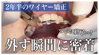 2年半のワイヤー矯正治療が終了！ブラケットを外す瞬間(ブラオフ)に密着【名古屋茶屋歯科・矯正歯科】