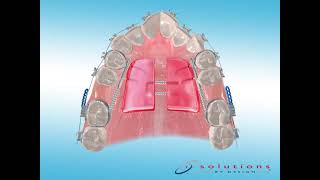 ScreenPlay Orthodontic Education Videos: Dynaflex DMAX 2000