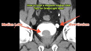 Tips for managing a large prostate median lobe- How to GreenLight laser prostatectomy