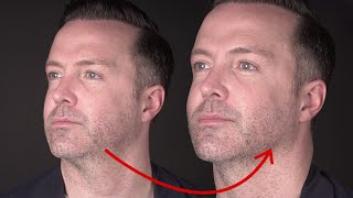 Injecting the male jaw | Create a sharp jawline \u0026 reduce a double chin