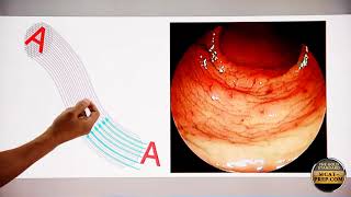 Exploring Total Internal Reflection in Fiber Optics, Endoscopy | MCAT Physics Review
