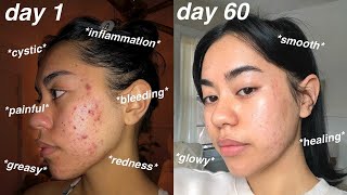 I CLEARED MY ACNE *60 days using Differin Gel Adapalene 0.1% + pictures!*