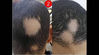 1#Interactive_Dermatology_Clinic Images 1 Herpes simplex 2 Alopecia areata 3 Aquired ichthyosis