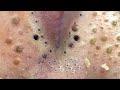 Big Cystic Acne Blackheads Extraction Blackheads & Milia, Whiteheads Removal Pimple Popping # 345