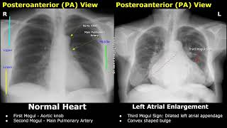 Chest X-Ray Heart Normal Vs Abnormal Image Appearances | Cardiac Diseases On Radiography (CXR)