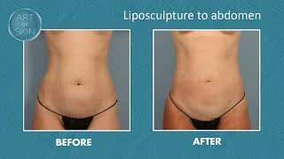 Liposuction with Local Numbing to Abdomen (Liposculpture)