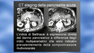 19 Pancreatite acuta. Lucio Olivetti