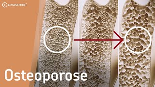 DARUM ist Osteoporose so gefährlich | Osteoporose in 100 Sekunden erklärt