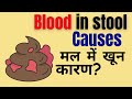 Blood in stool without pain and with pain in anus | Blood in stool causes